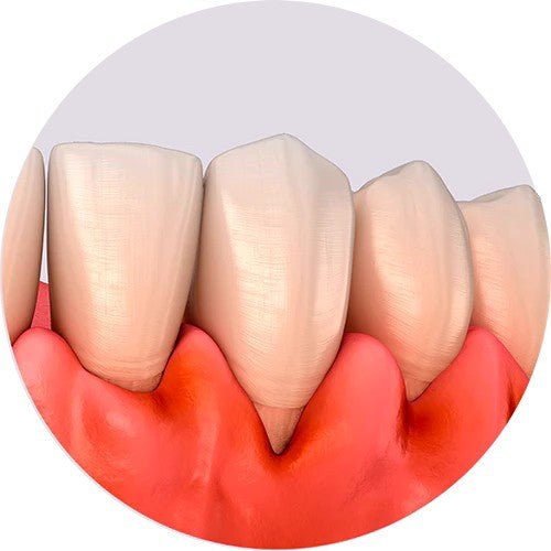 Dual light therapie thuis als ondersteuning voor parodontale zorg - Lumoral.