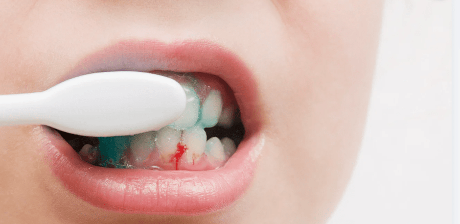 Bloedend tandvlees is geen diagnose - Lumoral.