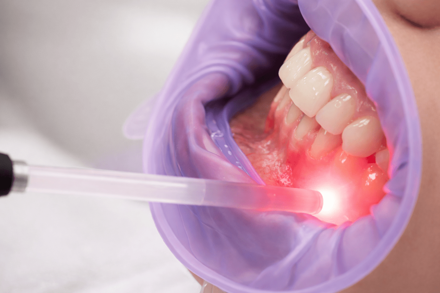 Fotobiomodulatie na tandheelkundige ingrepen en de rol van thuistoepassing - Lumoral.