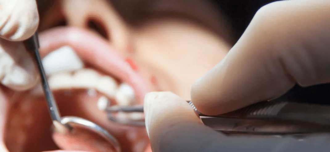 Mucositis in de mond: een ontsteking die de levenskwaliteit ernstig kan aantasten - Lumoral.