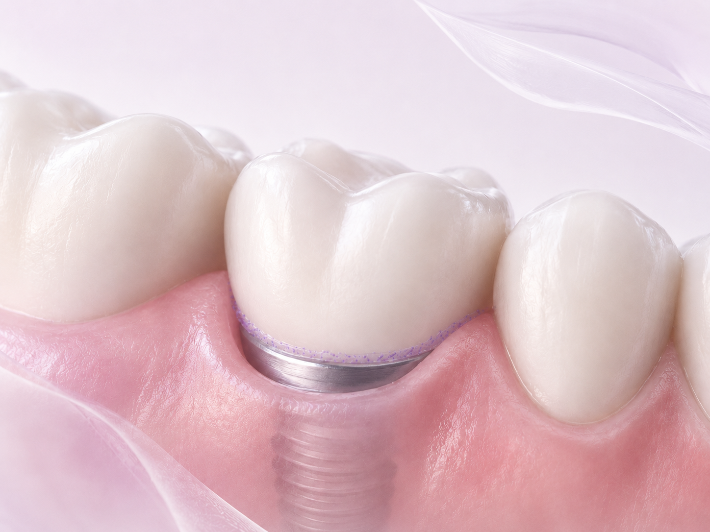 Biofilm rond restauraties